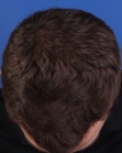 After Hair Transplant&nbsp;Hairlines